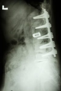 Pig Lumbar Spine Pedicle Screws